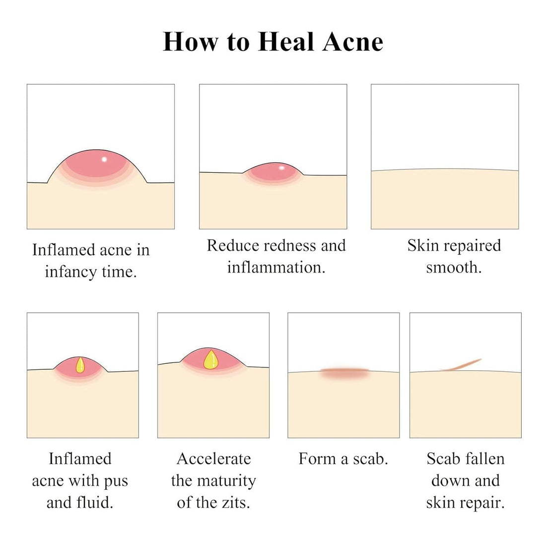 BREYLEE Acne Treatment Serum Face Facial Anti Acne Scar Removal Cream Skin Care Whitening Repair Pimple Remover For Acne